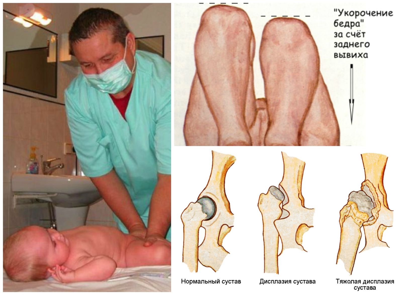 Дисплазия тазобедренных суставов у детей