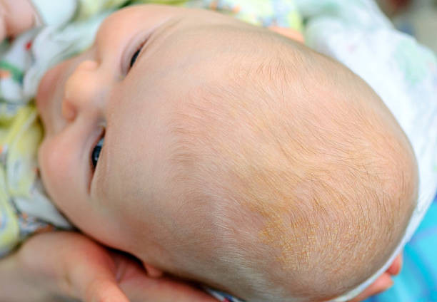 Избавление от молочных корочек у новорожденных: Забота о нежной коже малышей
