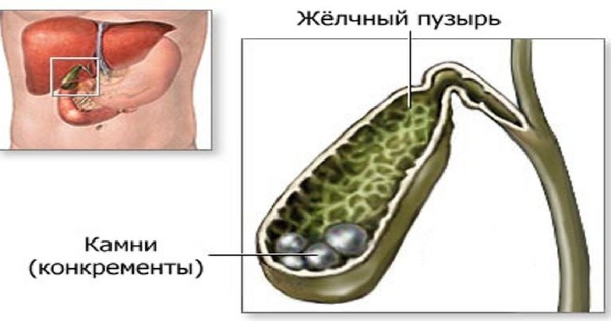 Продукты камни в желчном. Камни в протоках желчного пузыря. Камень в жёлчном пузыре 2 см. Камень в протоке желчного пузыря. Вырезанный желчный пузырь.