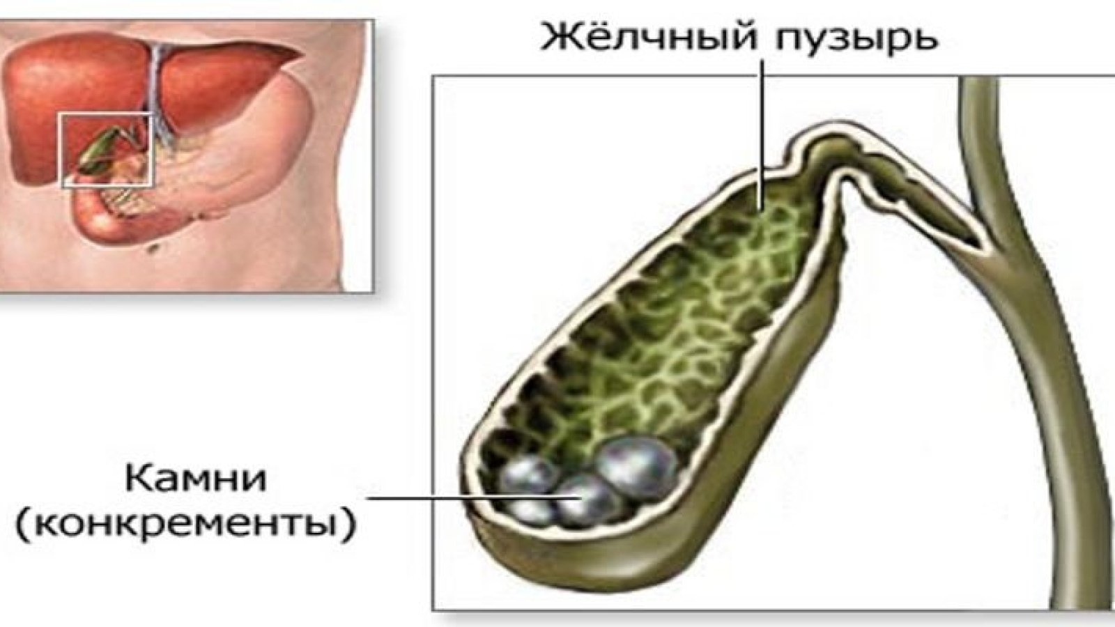 Эти два продукта эффективны для профилактики от камней в желчном пузыре -  Телеграф