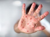 Эпидемия кори в Украине: что говорят в Министерстве здравоохранения