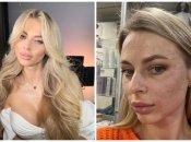 Девушка получила ожоги на лице