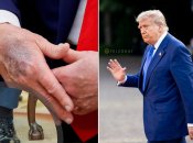 Язвы на руках Трампа