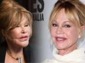 Топ-5 зірок, які зіпсували свою зовнішність пластикою