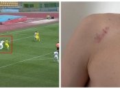 Олександр Назаренко показав своє "пошкодження"