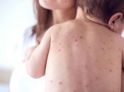 Особливо небезпечною ця хвороба може бути для дітей та вагітних