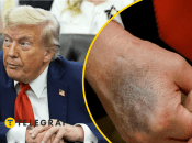 Дональд Трамп прикрывает синяк