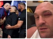 Тайсон Ф’юрі показав наслідки своєї травми