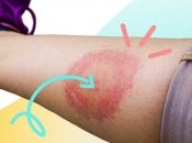 Так виглядає місце укусу кліща під час хвороби Лайма