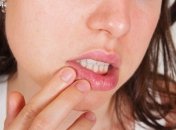 Все, что вы хотели знать о герпесе, но боялись спросить!