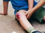 Какое самое эффективное средство от синяков? 