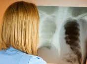 В мире эпидемия туберкулеза