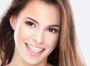 Як врятувати ваші зуби за допомогою брекетів