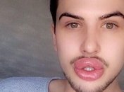 Парень потратил кучу денег на создание идеальных губ (Фото)