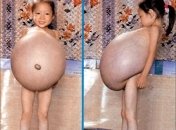 Четырехлетнюю девочку избавили от огромного живота (Фото)