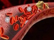 Врачи напомнили, к каким последствиям могут привести тромбы