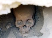 Найдены генетические причины врожденной деформации черепа