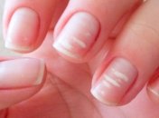 Врачи рассказали, из-за чего появляются белые пятна на ногтях