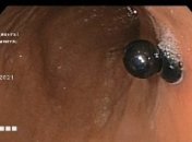 В Днепре спасали ребенка, который проглотил магнитные шарики: что делать в таких случаях