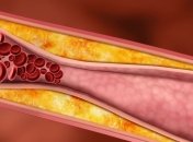 Что может очистить сосуды от холестерина 