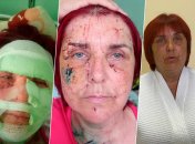 Лариса Шмалько постраждала під час ракетного обстрілу курортної Сергіївки