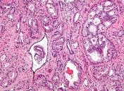 Революционный препарат от рака простаты скоро появится на рынке