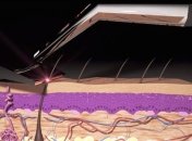 Лазерная бритва Skarp оказалась фальшивкой 