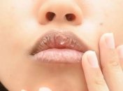 Почему трескаются губы и как с этим быть?