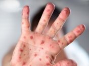 Вспышка кори: в Самоа объявили чрезвычайное положение 