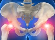 Симптомы и лечение артроза тазобедренного сустава