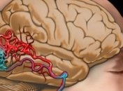 Проверенные способы бережной "чистки" сосудов мозга