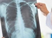 Минздрав: В Украине резко выросло число людей с пневмонией