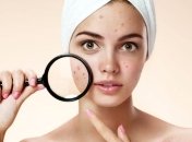 Косметологи подсказали, как подросткам ухаживать за кожей