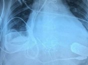 Операция успешная: "бионическое сердце" с возможностью беспроводной зарядки (Видео)