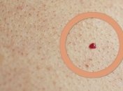 Что означают красные родинки на коже