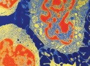 Найден уникальный белок, способный уничтожать быстрорастущие раковые клетки