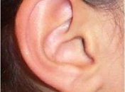 Мальчику сделали ухо из собственного ребра