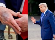 Виразки на руках Трампа