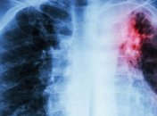 В Украине зарегистрировано инновационное лекарство против туберкулеза