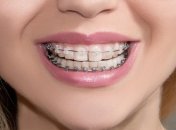 Исправление прикуса: проверенные временем способы и инновационные технологии