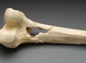 В Панаме в захоронении найден один из древнейших случаев рака кости