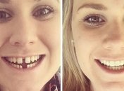 Эти люди исправили свои кривые зубы при помощи брекетов, и теперь их улыбка прекрасна (Фото) 