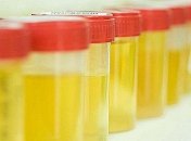 О каких проблемах организма может рассказать цвет и запах мочи