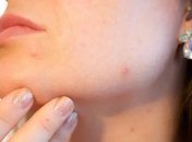 Диета от прыщей: ТОП-5 продуктов для идеальной кожи