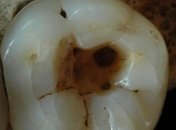 Исследователи обнаружили самые древние попытки лечения кариеса