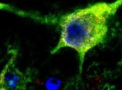 Ученые определили белок, способствующий восстановлению после инсульта