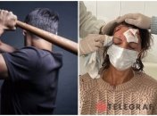 В ботсаду имени Гришко женщину шесть раз ударили битой по голове