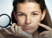 Как гормональный сбой влияет на появление акне 