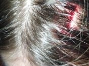 Син завуча в приватній школі чашкою розбив дівчинці голову, але винною зробили постраждалу: подробиці резонансної історії