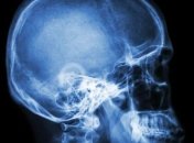 Превзошли все ожидания: новые наночастицы уменьшают отек мозга при травмах головы